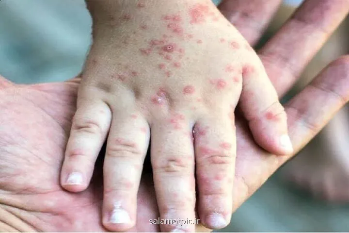 سرخک یکی از مسری ترین بیماریها این فیلم را ببینید