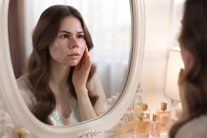 چرا هر کاری می کنم باز جوش می زنم؟